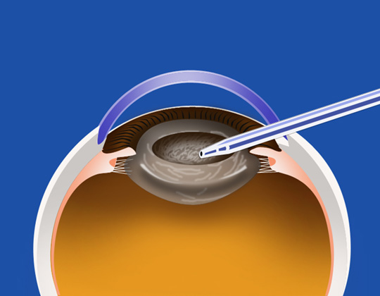 白内障手術