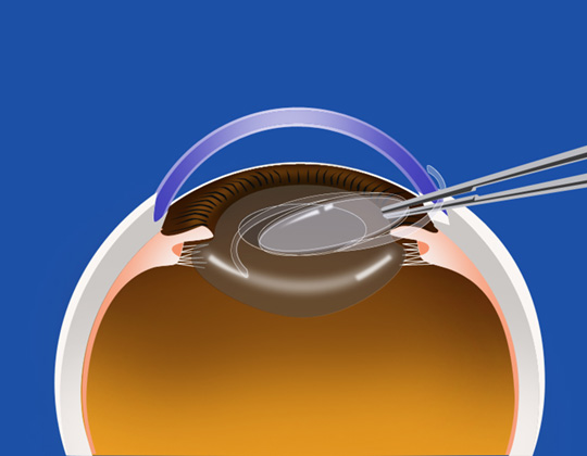 白内障手術
