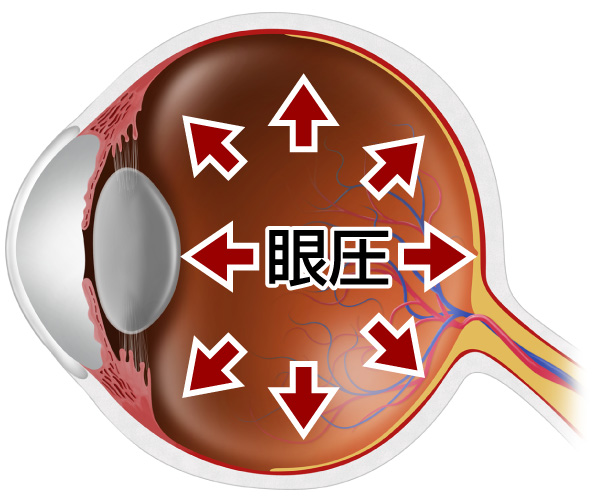 緑内障眼圧